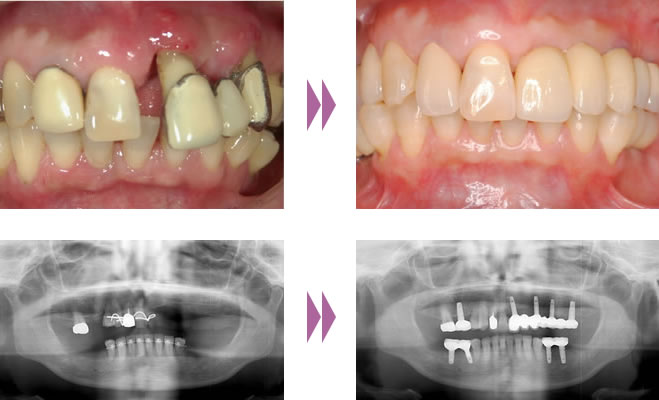 歯周病のインプラント症例