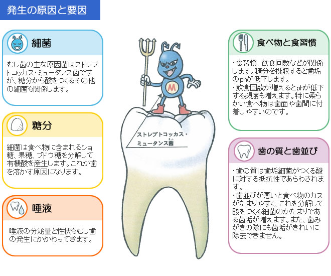虫歯の発生と要因