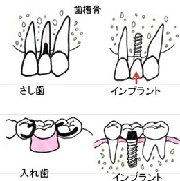 インプラントとさし歯の違い