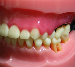 歯ぐき腫れ
