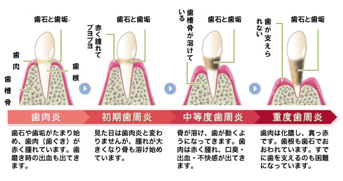 歯周病の進行過程
